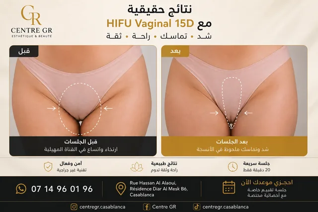تطور الاستجابة مع تقنية HIFU Vaginal 15D حسب الحالة
